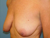 Patient # 90585 Before Photo # 3