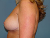 Patient # 34305 After Photo # 6