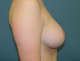Patient # 33305 After Photo # 10