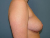 Patient # 44165 After Photo # 10