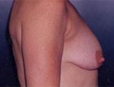 Patient # 83140 Before Photo # 3
