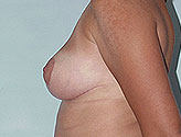 Patient # 10687 After Photo # 6