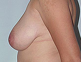 Patient # 10687 Before Photo # 5