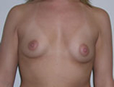 Patient # 67101 Before Photo # 1