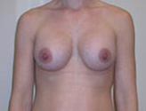 Patient # 91096 After Photo # 2