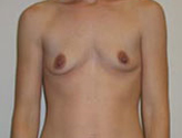 Patient # 91096 Before Photo # 1