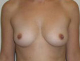 Patient # 59567 Before Photo # 1