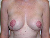 Patient # 26152 After Photo # 2