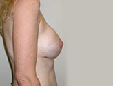 Patient # 26152 After Photo # 4