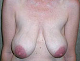 Patient # 26152 Before Photo # 1