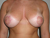 Patient # 68113 After Photo # 4