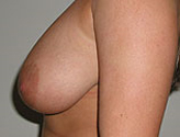 Patient # 68113 Before Photo # 1