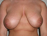 Patient # 68113 Before Photo # 3