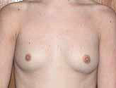 Patient # 10795 Before Photo # 1