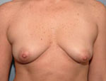Patient # 89981 Before Photo # 1