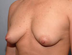 Patient # 89981 Before Photo # 3