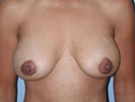 Patient # 37377 After Photo # 2