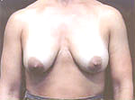Patient # 58376 Before Photo # 1