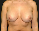 Patient # 37729 After Photo # 2