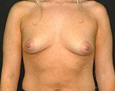 Patient # 37729 Before Photo # 1