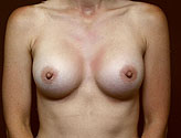 Patient # 46409 After Photo # 2