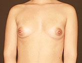 Patient # 41244 Before Photo # 1