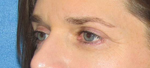 Patient # 30715 After Photo # 4