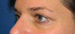 Patient # 30715 Before Photo # 3