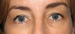 Patient # 14373 Before Photo # 1