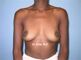 Patient # 60301 Before Photo # 1