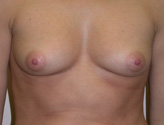 Patient # 83569 Before Photo # 1