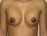 Patient # 65097 After Photo # 2