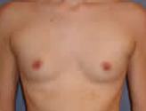 Patient # 44235 Before Photo # 1