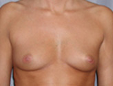 Patient # 67392 Before Photo # 1