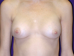 Patient # 45178 After Photo # 2