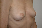 Patient # 87691 Before Photo # 7