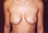 Patient # 26122 Before Photo # 1