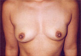 Patient # 45557 Before Photo # 1