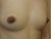 Patient # 22232 Before Photo # 1