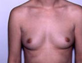 Patient # 86542 Before Photo # 1