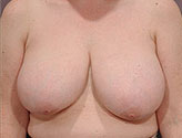 Patient # 77360 Before Photo # 1