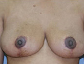 Patient # 92578 After Photo # 2