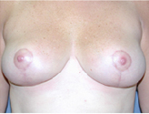 Patient # 61960 After Photo # 2