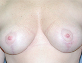 Patient # 60118 After Photo # 2