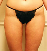 Patient # 97049 After Photo # 2