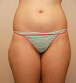 Patient # 96283 After Photo # 2