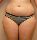 Patient # 96283 Before Photo # 1