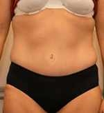 Patient # 53122 After Photo # 2