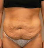 Patient # 53122 Before Photo # 1