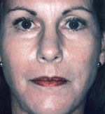 Patient # 76067 After Photo # 2
